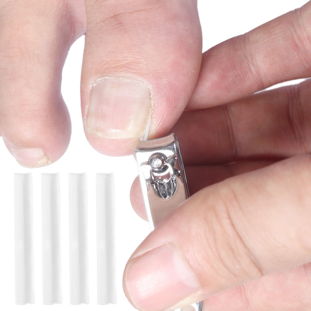 Corrección de uñas encarnadas