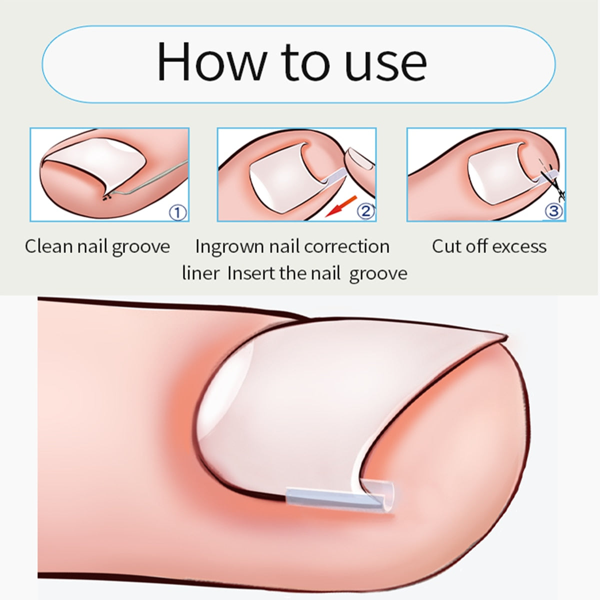 Corrección de uñas encarnadas