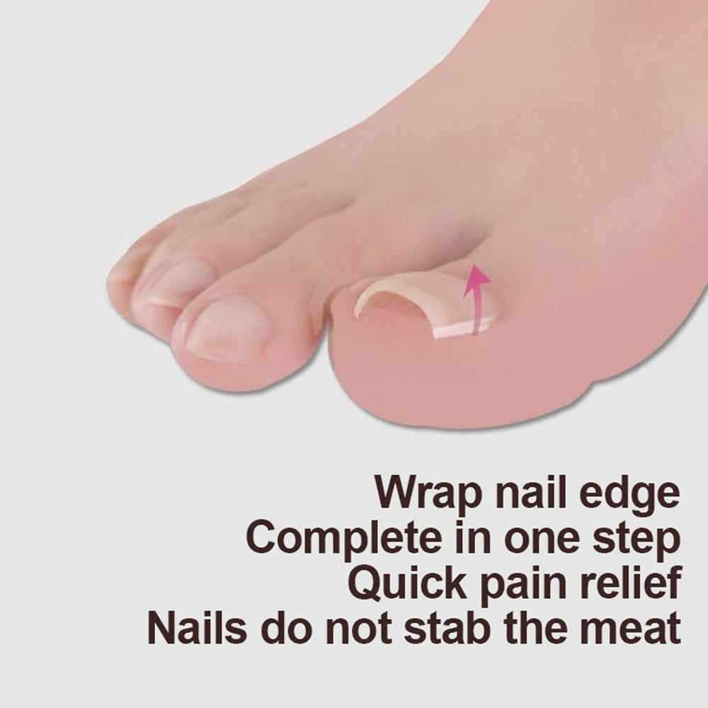 Corrección de uñas encarnadas