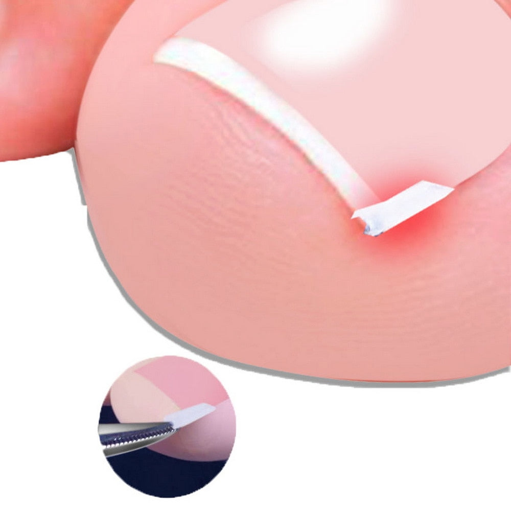 Corrección de uñas encarnadas