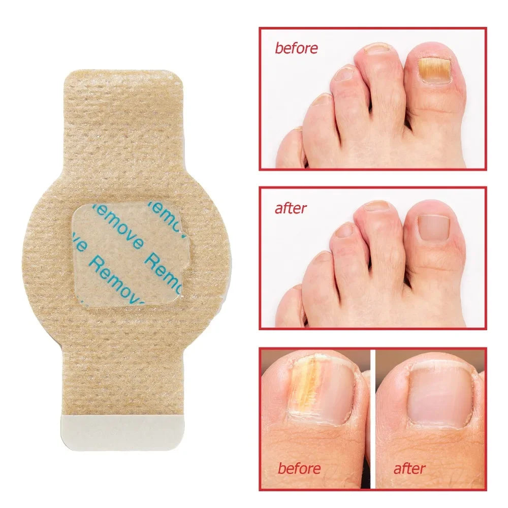 #1 Fungal Nail Patches (21 PCS)