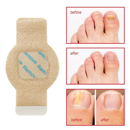 #1 Fungal Nail Patches (21 PCS)