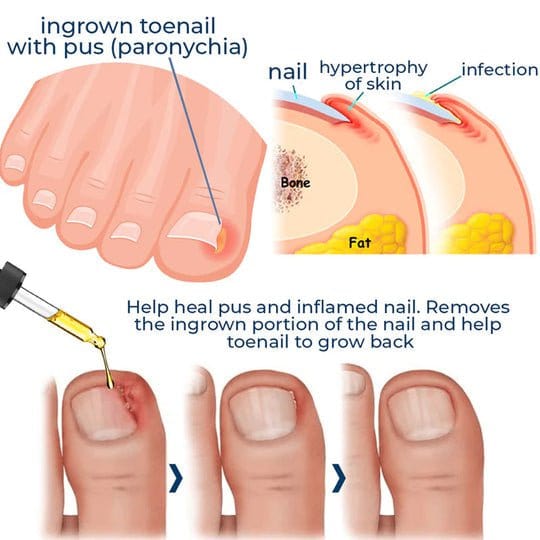 German ToenailPlus™ Anti-Paronychia Relief Oil