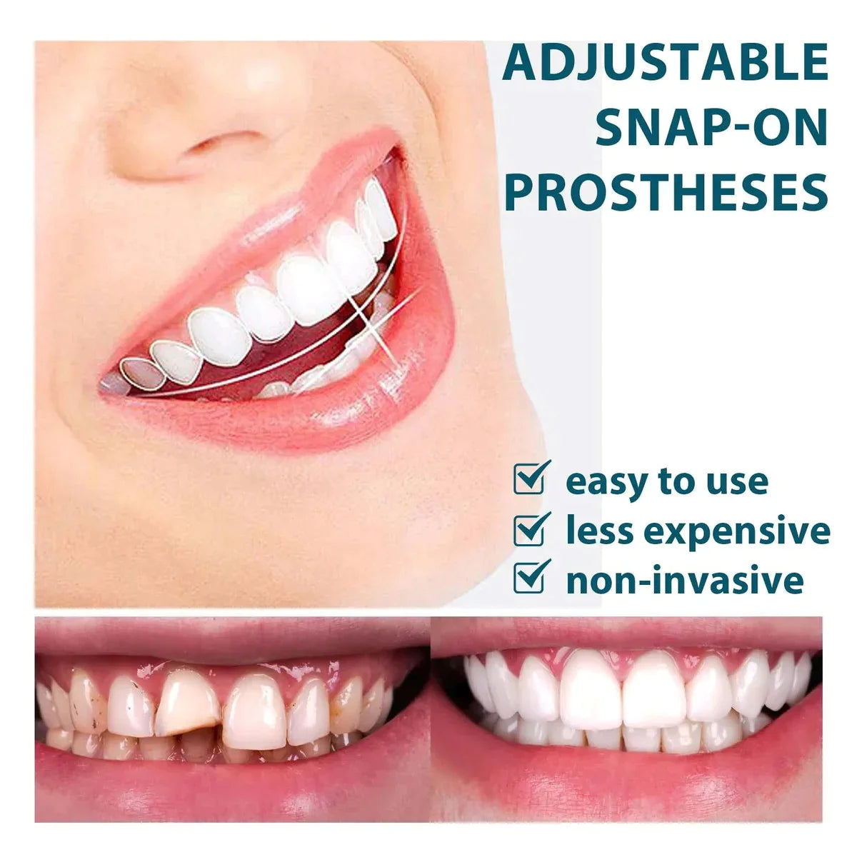 Prótesis dentales ajustables a presión 