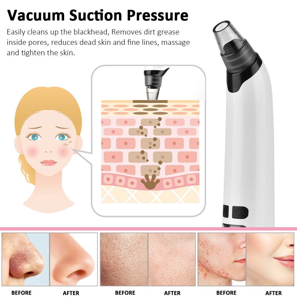 Blackhead Vacuum Suction