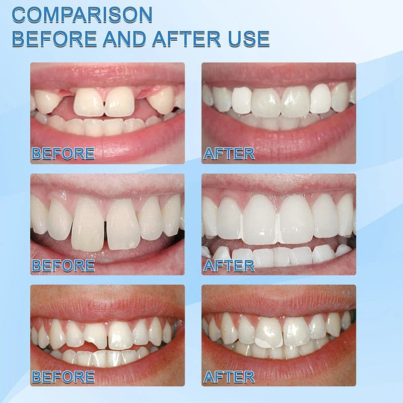 Fsyser™ Tooth Repair Granules